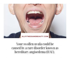 hae can cause a swollen uvula