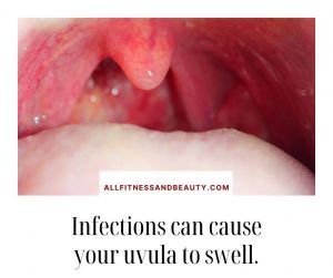 infections can cause a swollen uvula